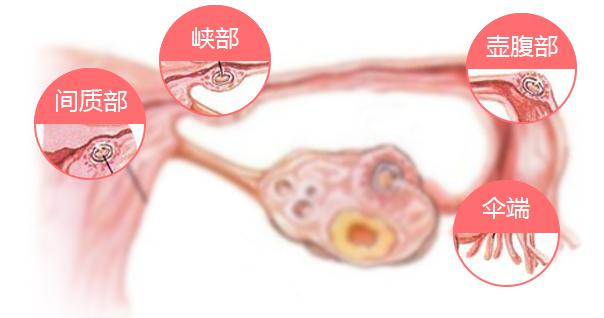 郑州天伦不孕不育专家告诉您输卵管阻塞的原因！