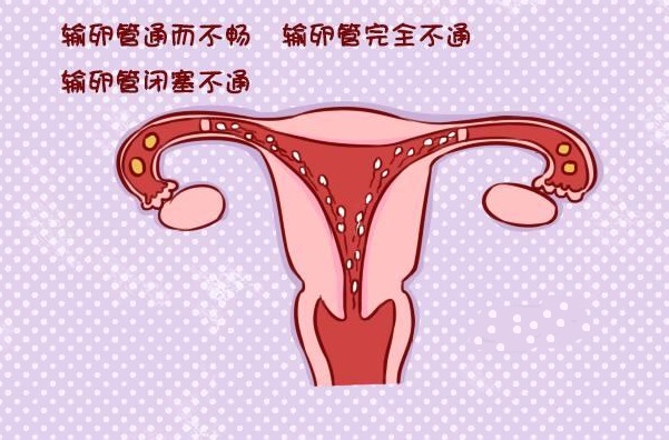  输卵管通而不畅对女性有什么影响?