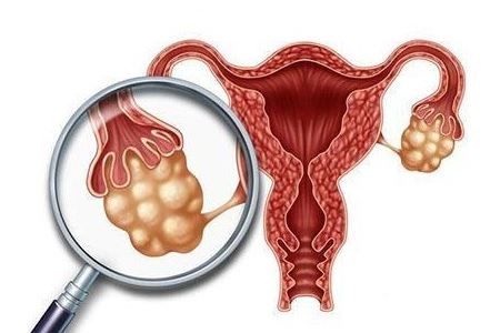 多囊卵巢是什么样的症状表现？