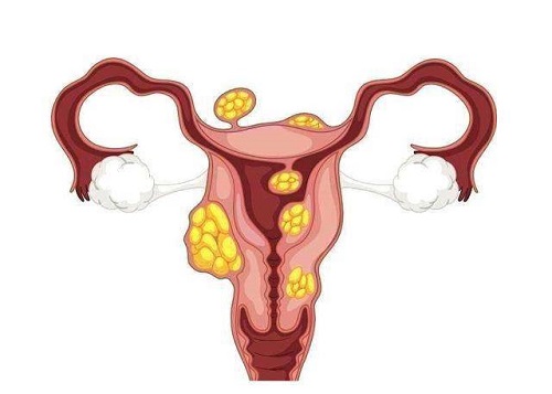 输卵管粘连是什么原因引起？应该怎么治疗？