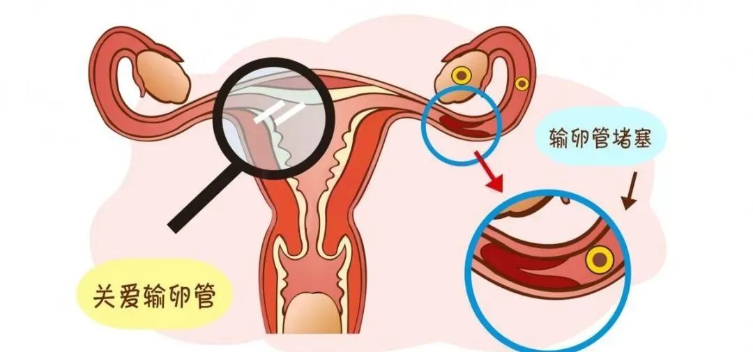 女性输卵管堵塞是什么原因造成的？