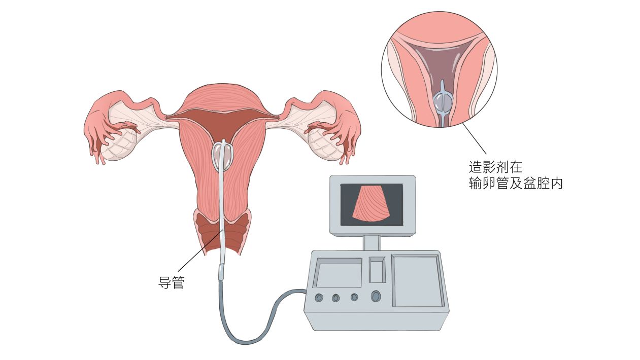 输卵管造影是什么?需要注意什么问题?