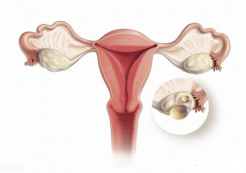多囊卵巢是如何引起的?生活中该如何调理?