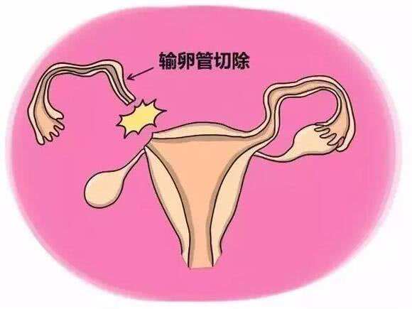 只有一边输卵管怎么样才能快速怀孕?