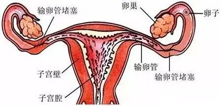 输卵管两侧堵塞怀孕的几率有多少