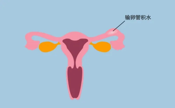 重庆正规不孕不育医院|输卵管积水为什么影响怀孕?