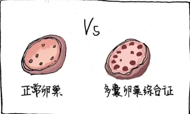 郑州市不孕不育医院哪家好?多囊卵巢综合症治疗需要多少钱?
