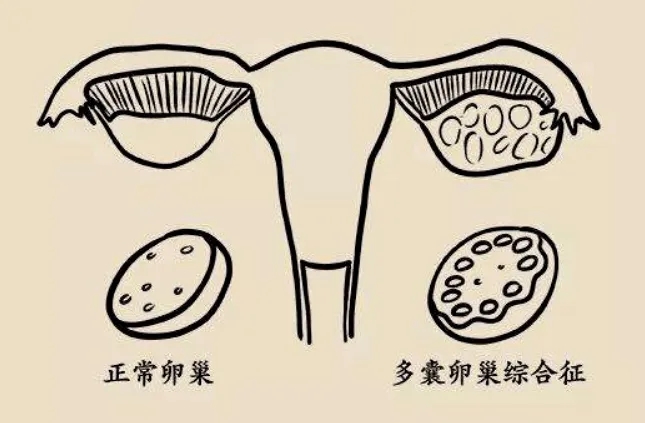 郑州正规的不孕不育医院有哪些?多囊患者可以自然排卵吗?