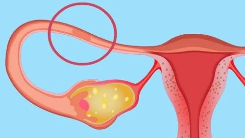 输卵管通而不畅可以怀孕吗?