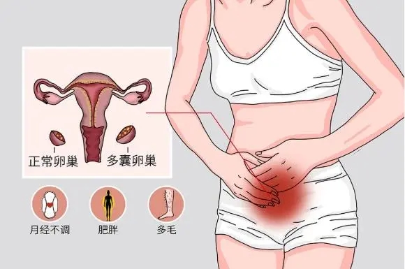 郑州哪家不孕不育医院比较好?多囊卵巢综合征有什么症状?