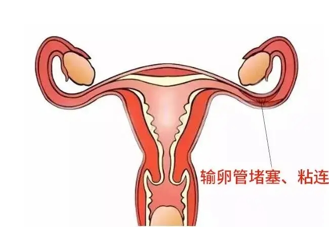 输卵管有问题该如何备孕?