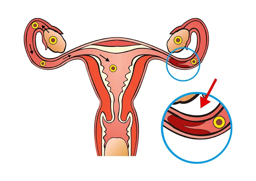 输卵管粘连能自然怀孕吗有哪些症状?