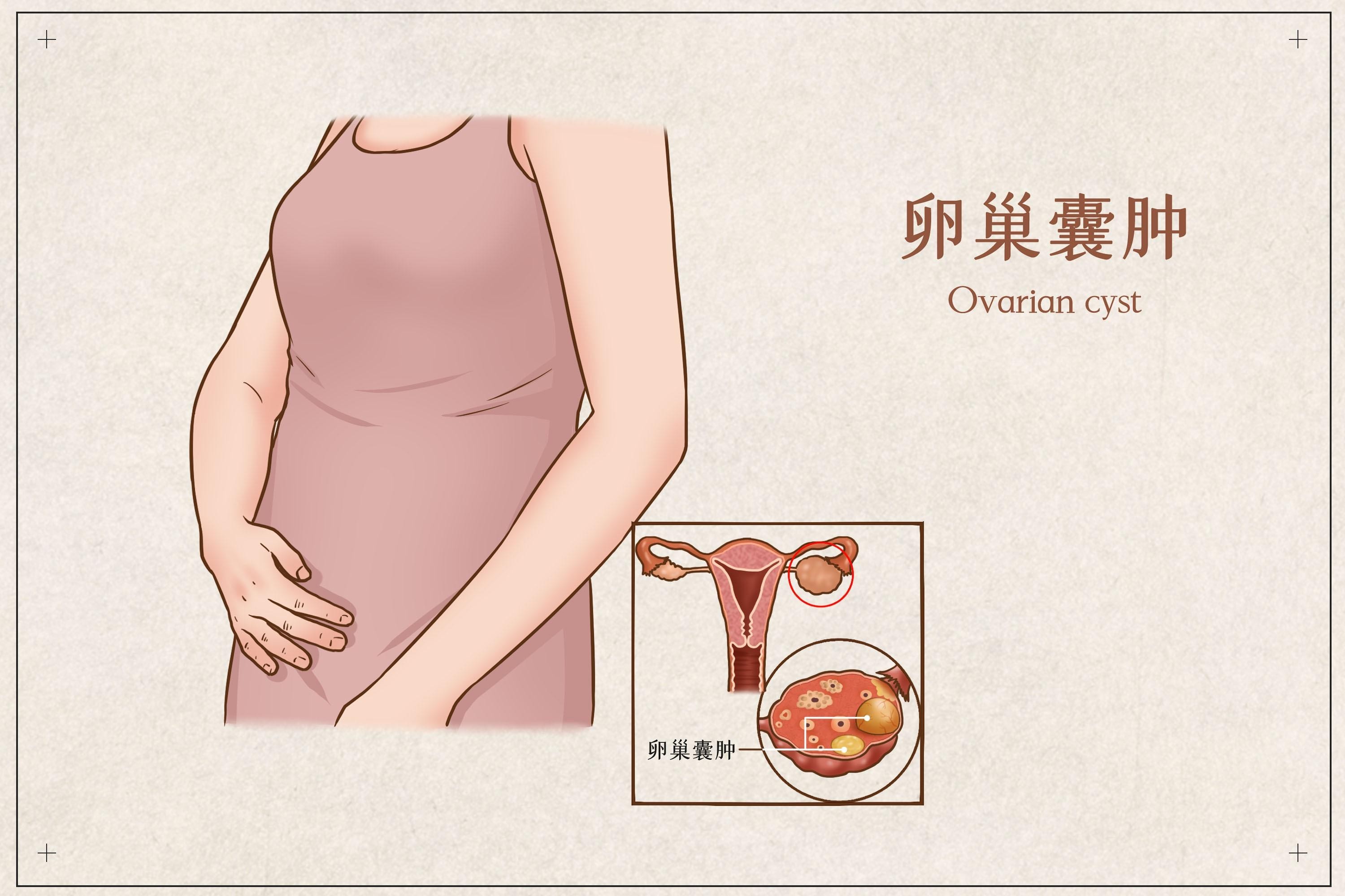 卵巢囊肿会影响女性怀孕吗?