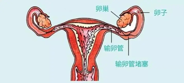 女性输卵管出现问题怎么办?